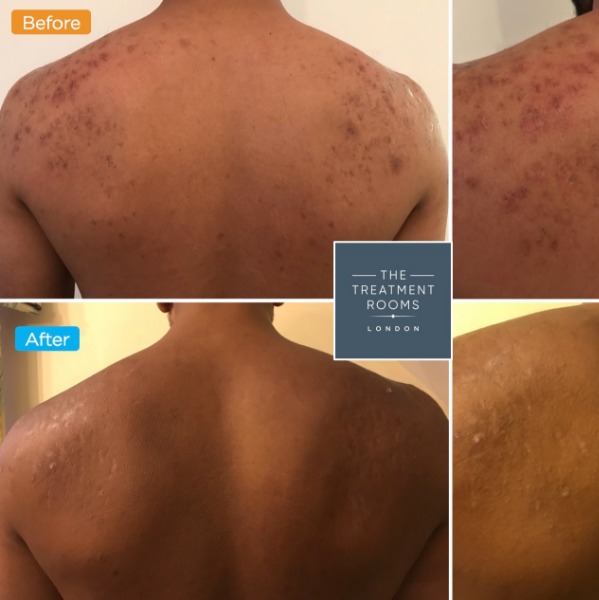 Acne Scarring therapy